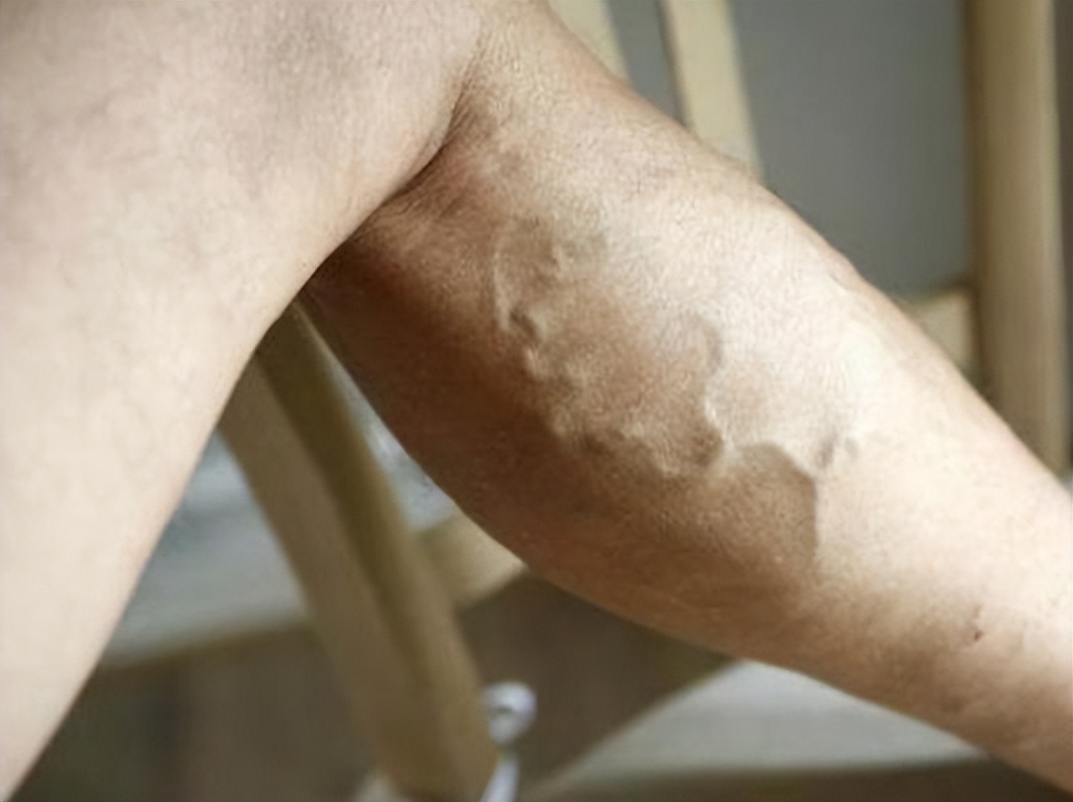 静脉曲张吃草药能疏通吗,静脉曲张只需四味药