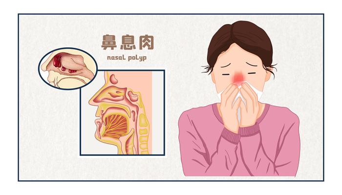 鼻息肉手术后要预防什么,怎样预防鼻窦炎和鼻息肉