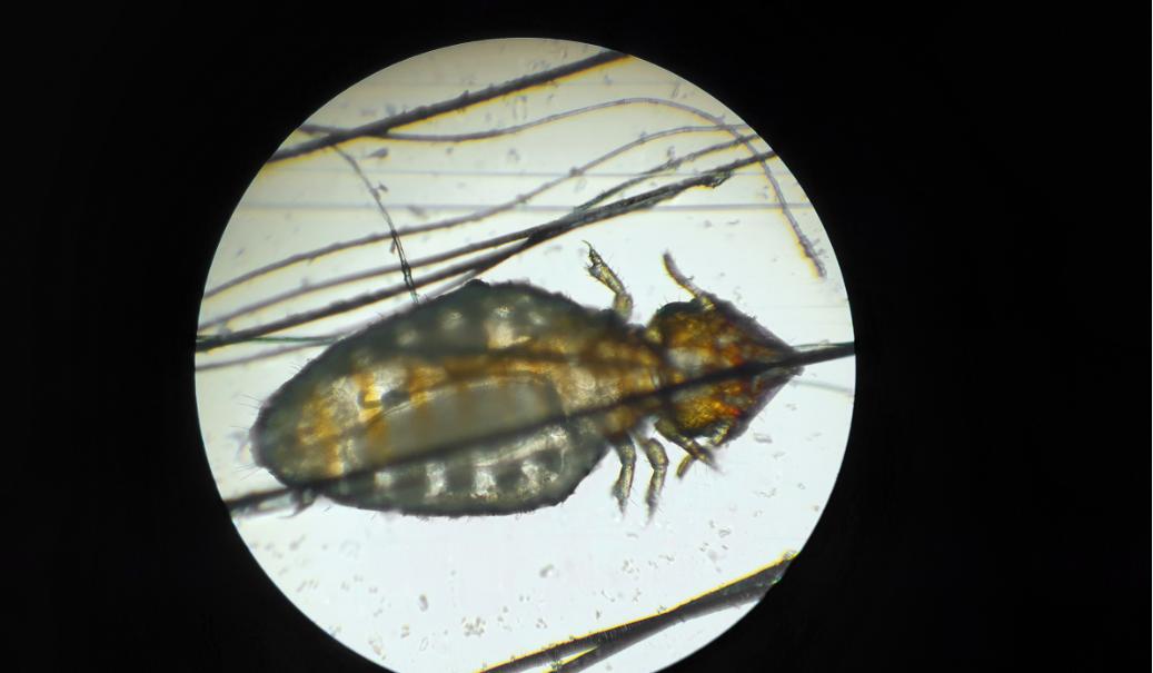 工厂打工爱上了大18岁大叔，确定后次日下身瘙痒难耐，原来是阴虱