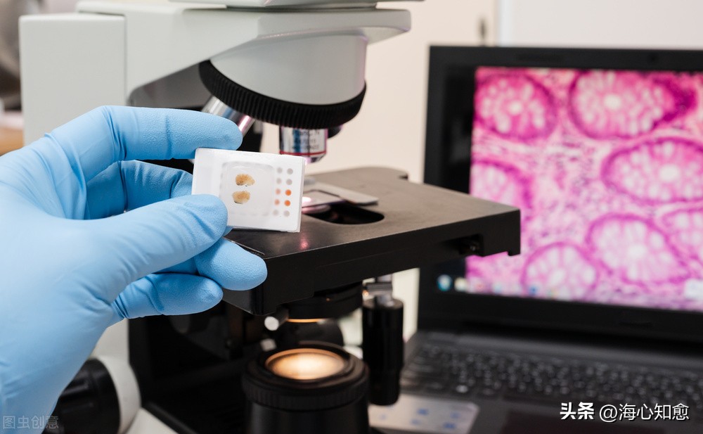 病理诊断初步考虑为恶性肿瘤,病理检查考虑恶性肿瘤是什么意思