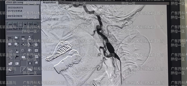 广州中山肿瘤医院喉癌治愈率,广州哪个肿瘤医院治疗喉癌最好