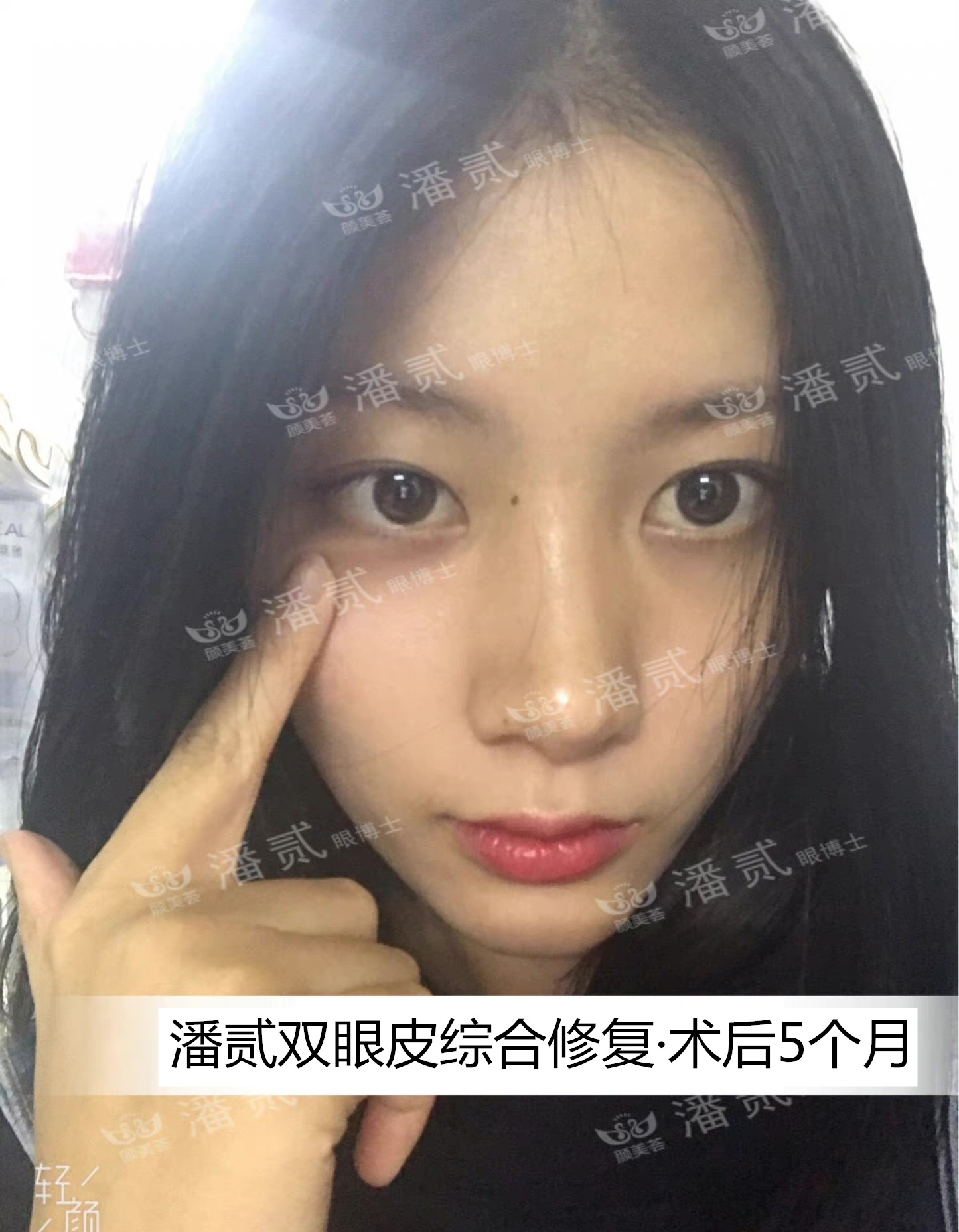 双眼皮贴导致眼皮破了,双眼皮贴导致眼皮严重下垂恢复