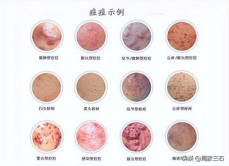 疮毒治疗中成药,治疗疮疡的用药