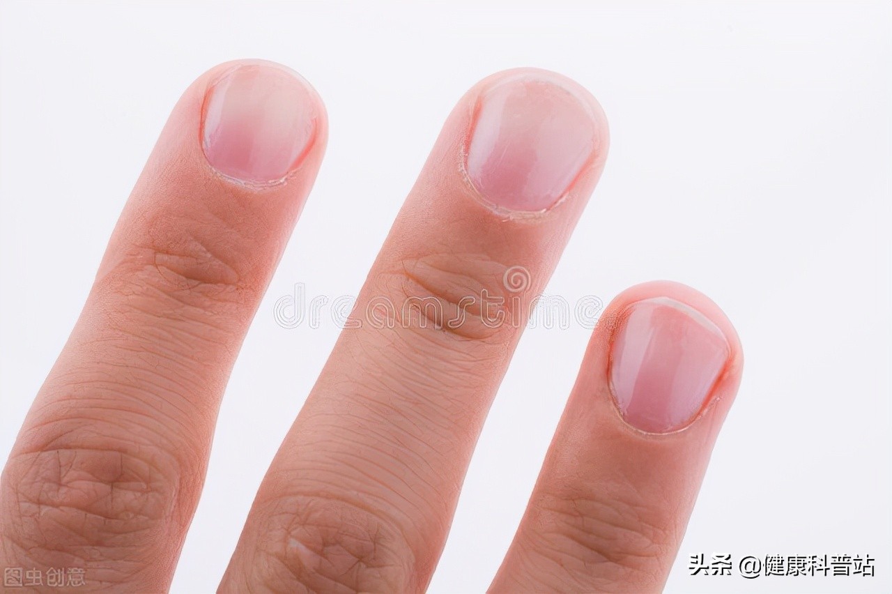 指甲盖抽烟黄了怎么避免,指甲盖发黄是病吗