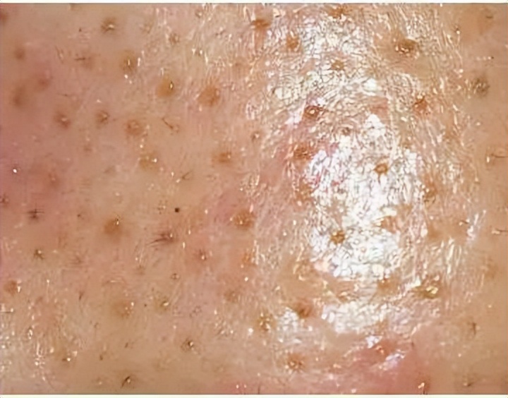 清洁面膜可以去黑头粉刺闭口吗,清洁面膜可以去除黑头吗