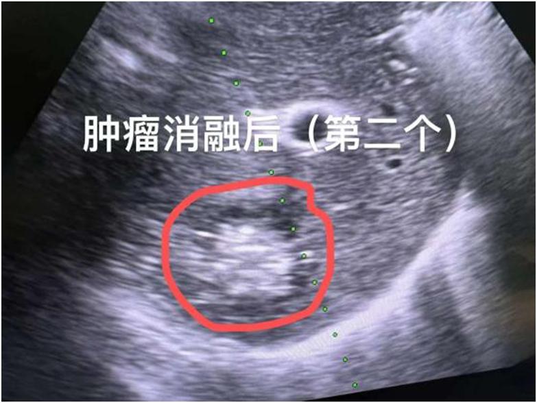 肝癌复发可用激光治疗吗,9公分的肝癌可以做微波消融么