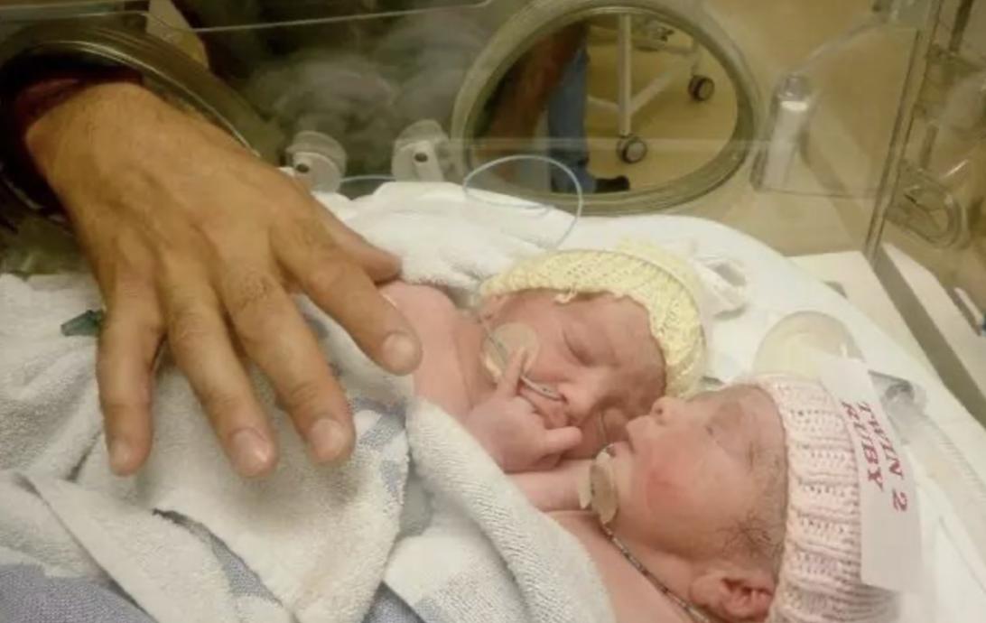 连体婴是不是有的共用一个大脑,两个大脑控制一个身体