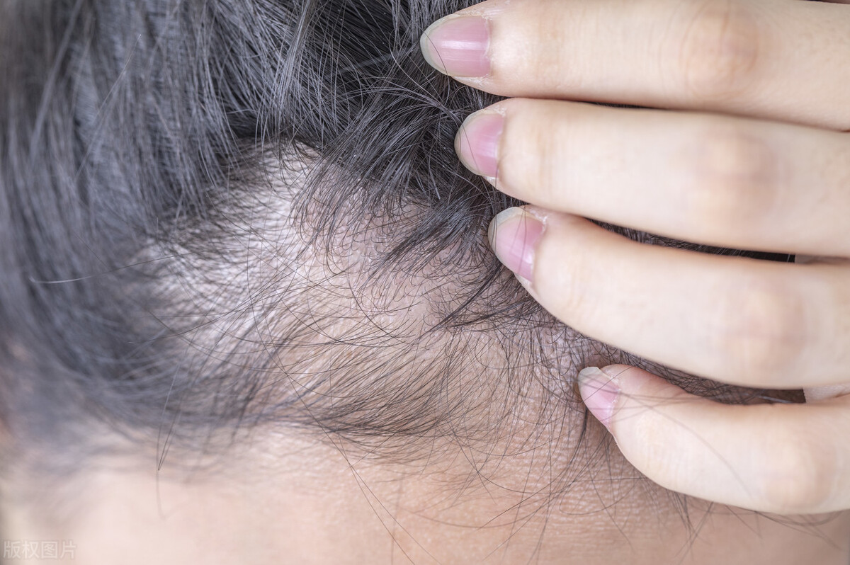 新手米诺地尔选择 (比较好用的米诺地尔)