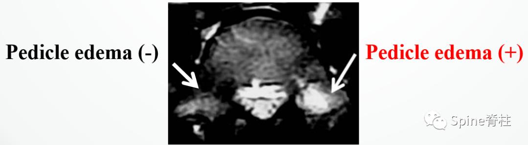 轻度峡部裂和重度峡部裂的区别,真性峡部裂和假性峡部裂