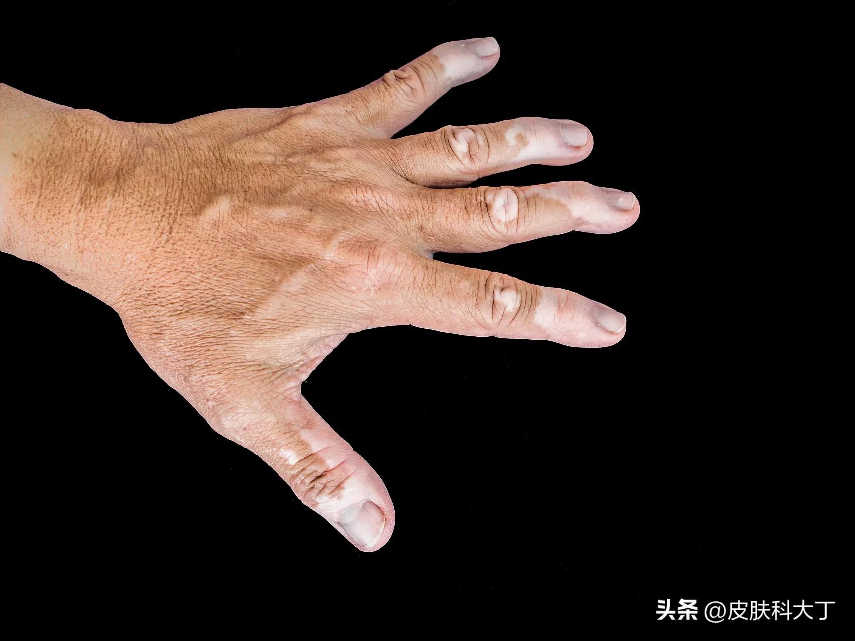怎么让白癜风黑色素全部退掉,手上白癜风最佳治疗方法