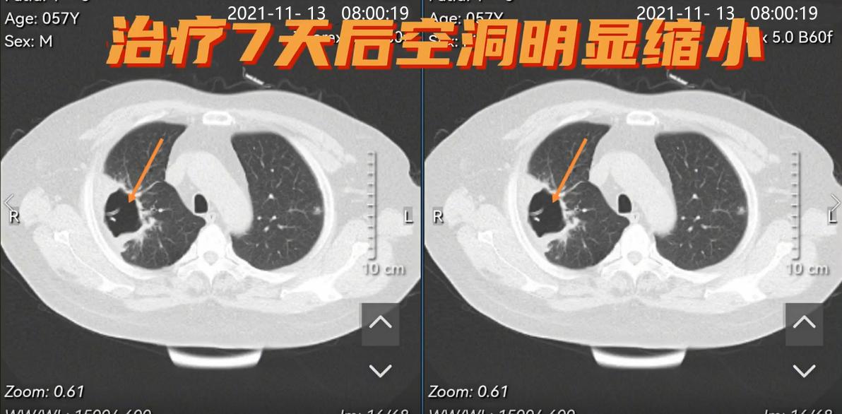 女52岁咳嗽咯血的ct诊断,老是咳嗽结果是肺脓肿