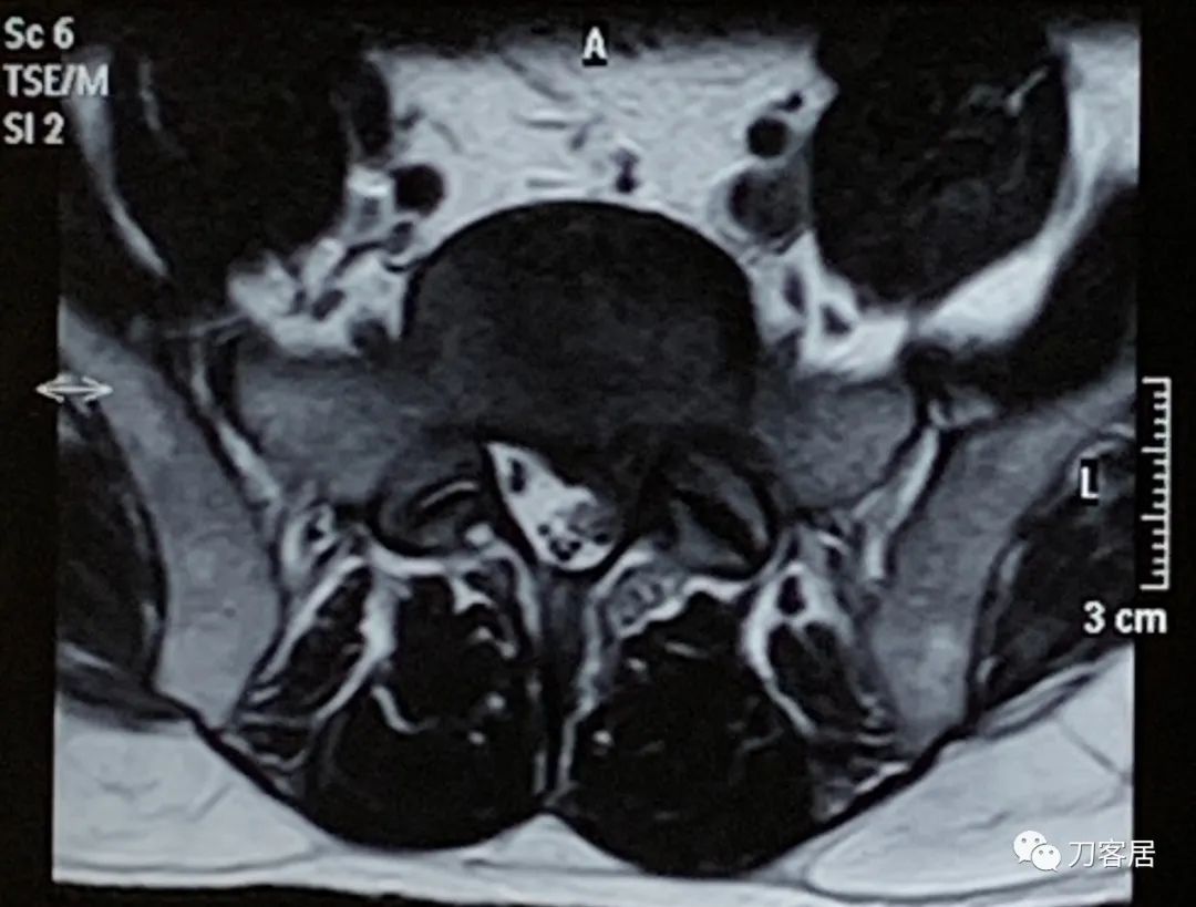 20岁腰5骶1椎间盘突出怎么办,腰5骶1椎间盘突出急性发作