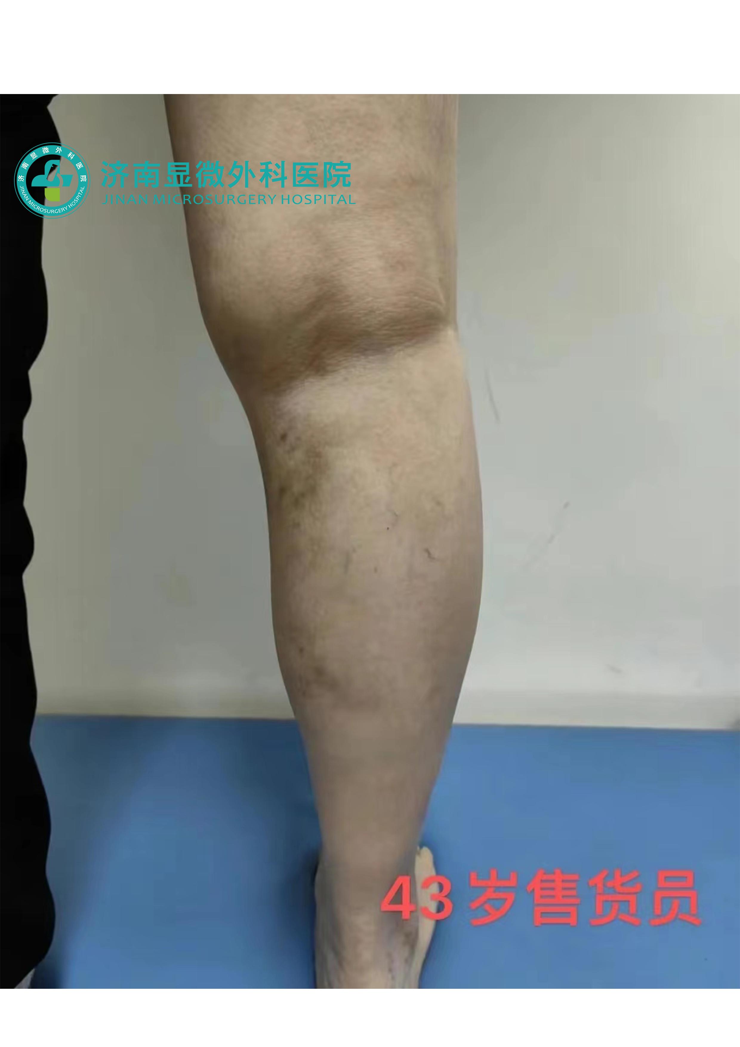 治疗下肢静脉曲张微创疗法是什么,静脉血管曲张手术治疗