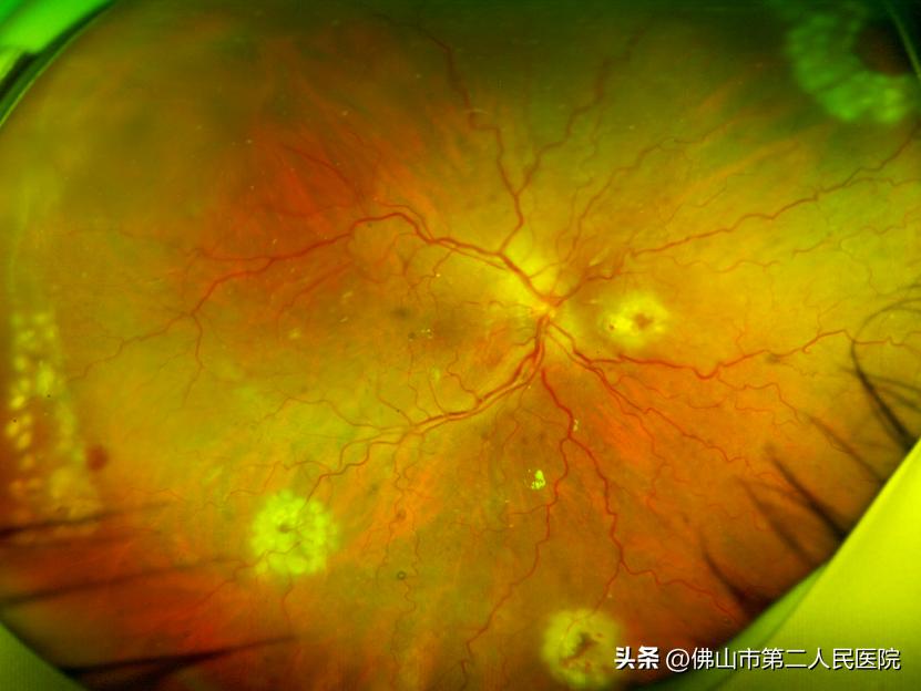 眼睛突然看不见视网膜脱落,视网膜脱离眼睛失明能看好吗