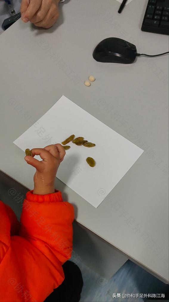 婴儿大拇指畸形怎么矫正,宝宝畸形手指