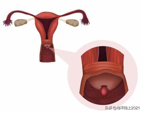 女性宫颈为啥老出问题,宫颈常见问题有哪些