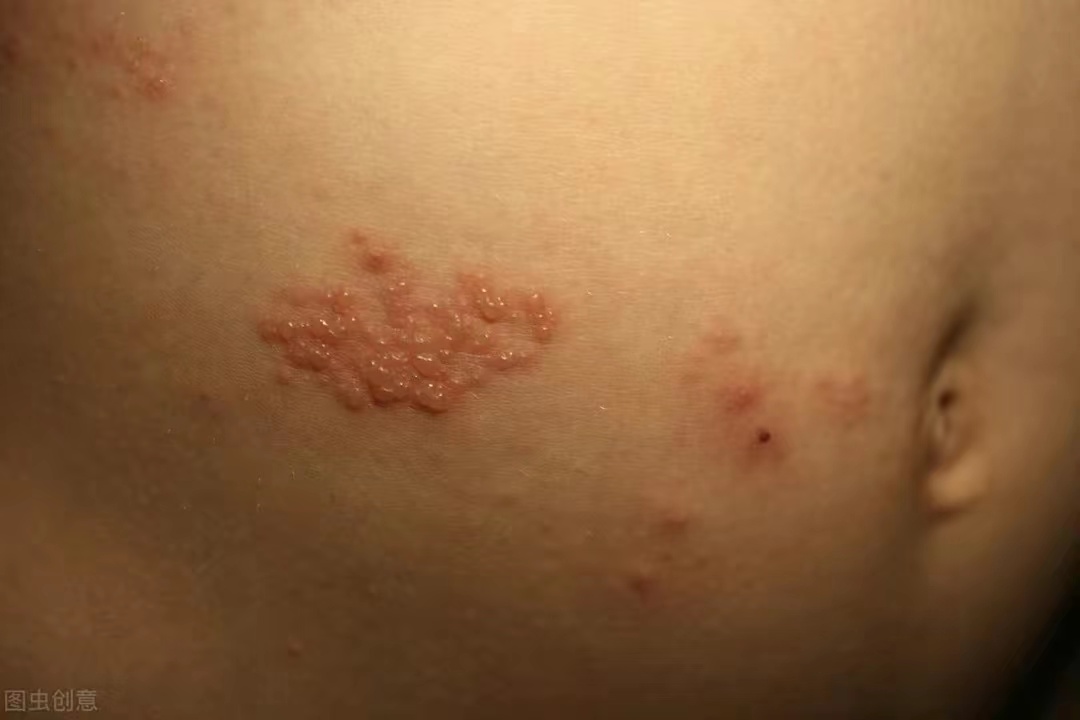 缠腰蛇带状疱疹专用药,蛇缠腰带状疱疹最佳治疗方法