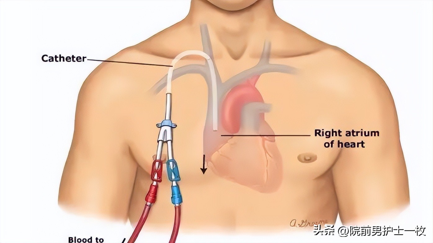 picc置管技术大全,picc置管操作流程