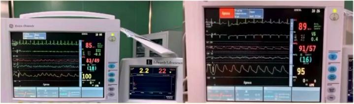 室上速发作的原因,室上速频繁发作的原因