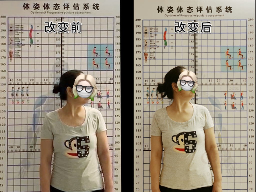 颈椎间盘突出压迫桡神经怎么恢复,颈椎间盘突出压迫手指麻怎么治疗