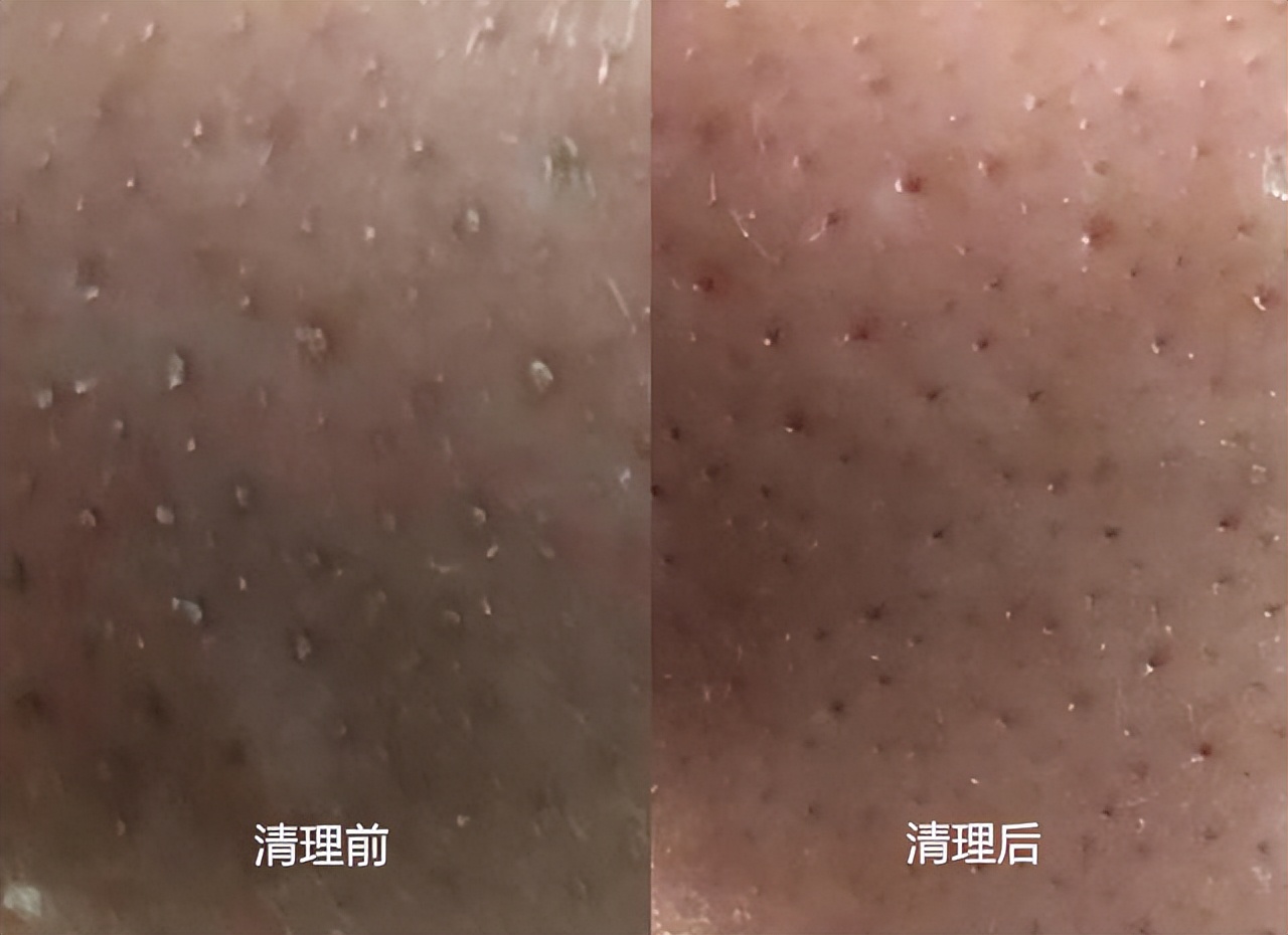 20年的黑头有多大,世界上最长的黑头到底有多长