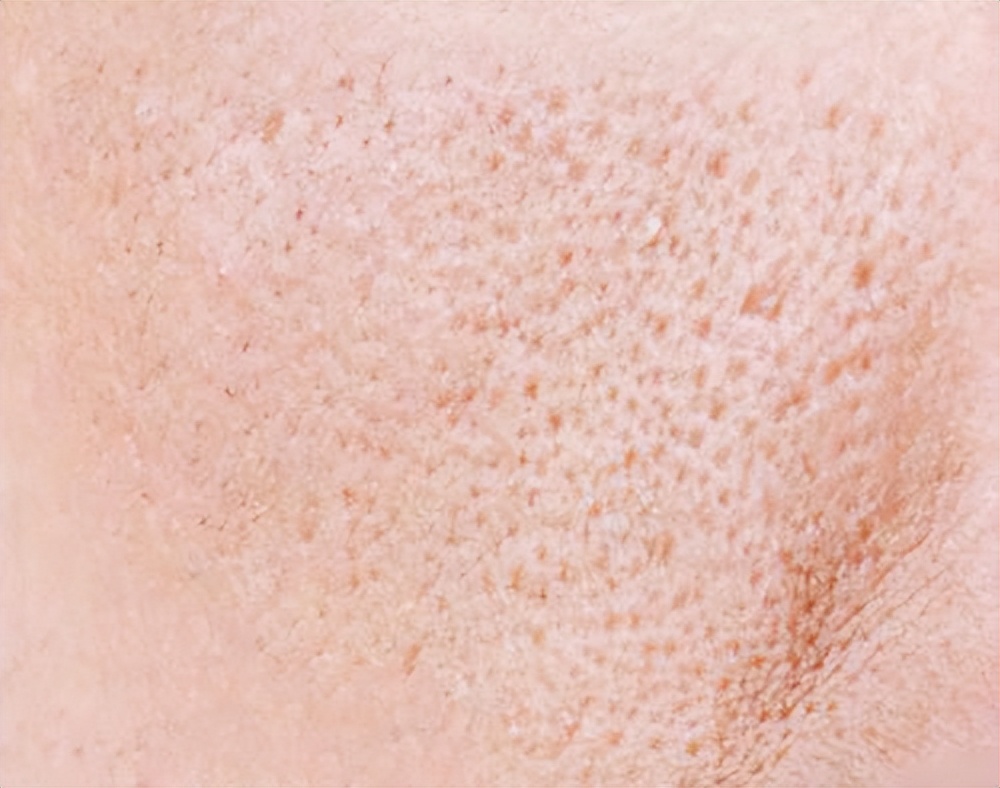 针对粉刺油性皮肤的爽肤水,爽肤水收缩毛孔的正确使用方法