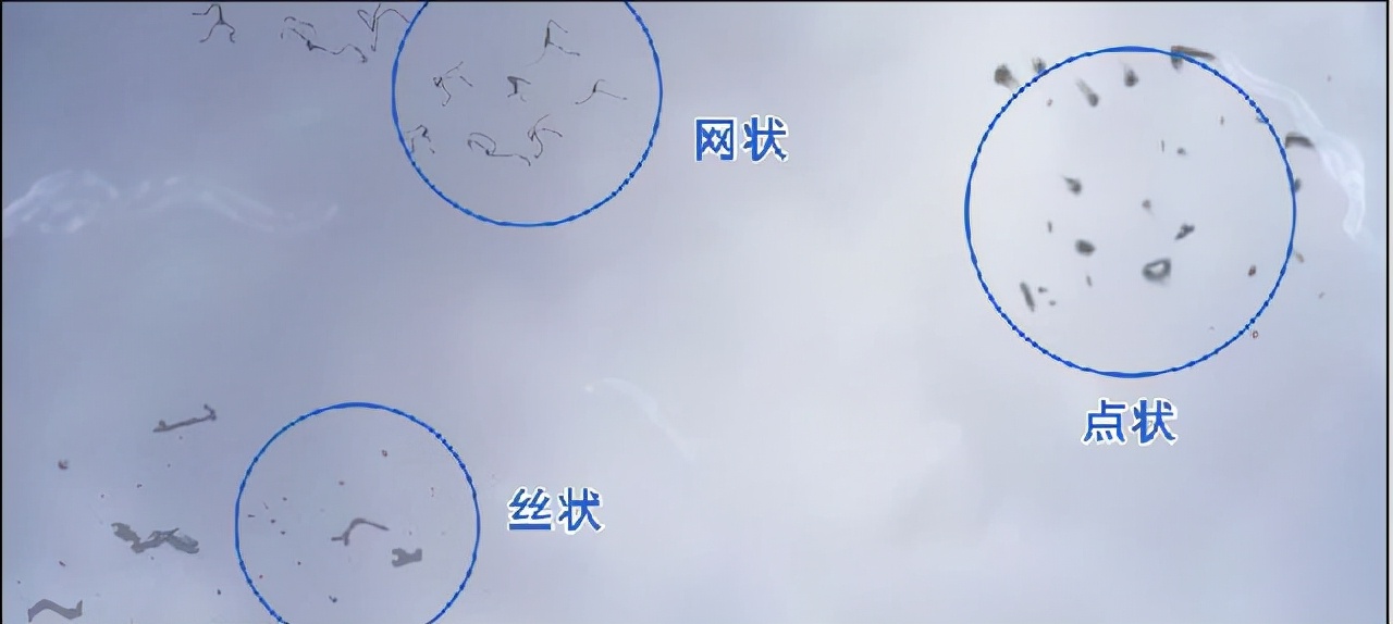 眼前只有一个小黑点算是飞蚊症吗,眼前有飞蚊症怎么办