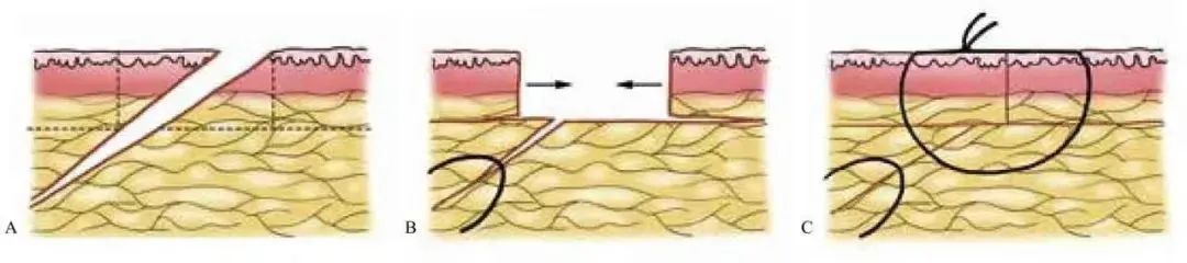 外科顶级缝针技术,外科缝合的操作细节你掌握多少