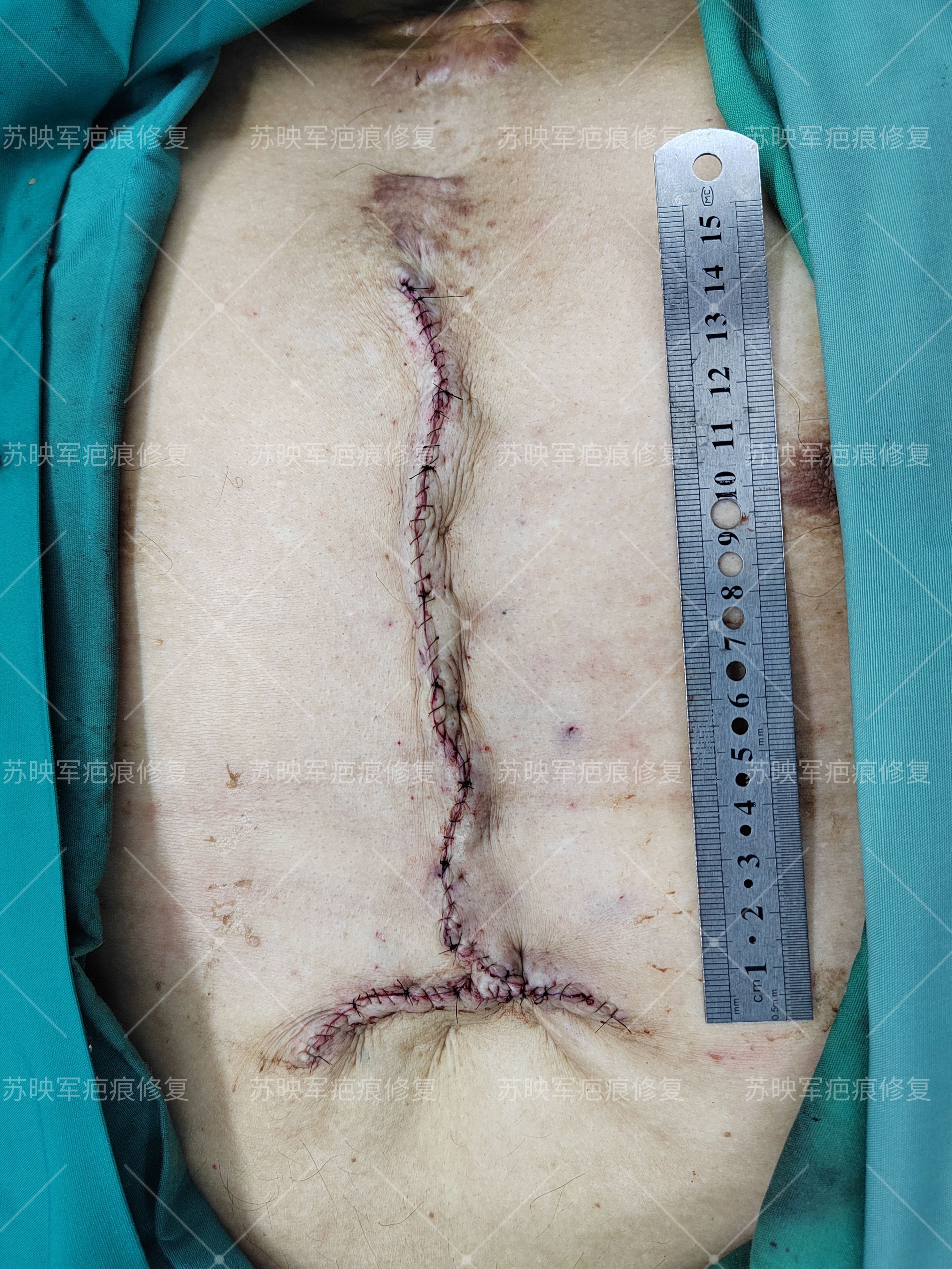 破溃流脓怎么处理,瘢痕疙瘩流脓切开引流