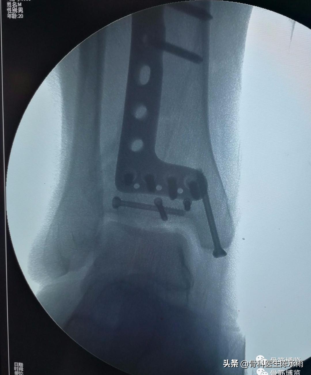 鑴氳笣楠ㄦ姌澶栧浐瀹氭敮鏋跺悗鎬庝箞鎭㈠,鑴氳笣楠ㄦ姌鐭宠啅鍜屽浐瀹氭敮鍏峰摢涓ソ