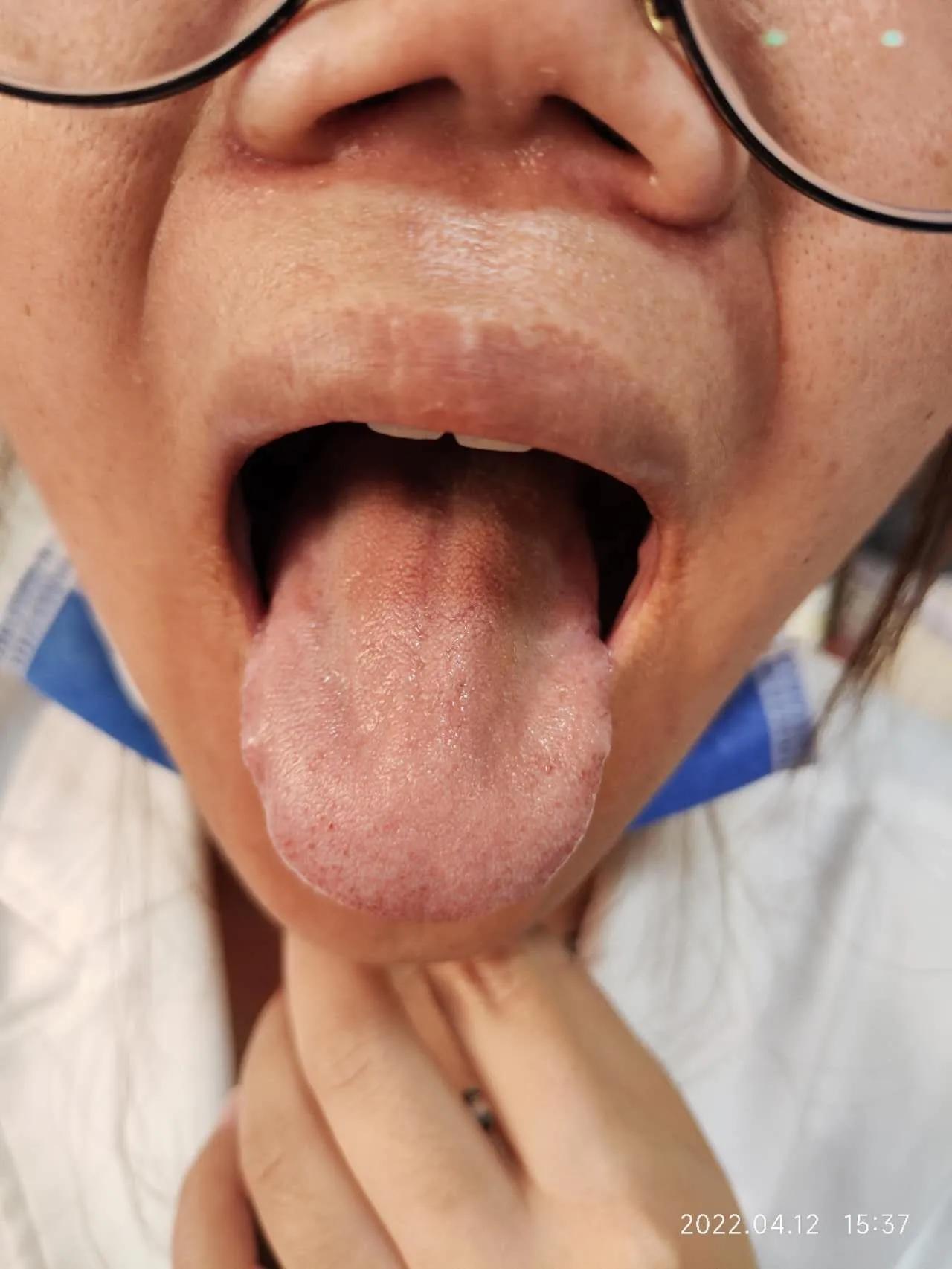 针药并用对发热的治疗效果如何,针药并用好处