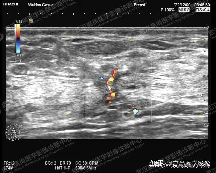 乳腺超声病例,乳腺肿块巨大超声结果4a