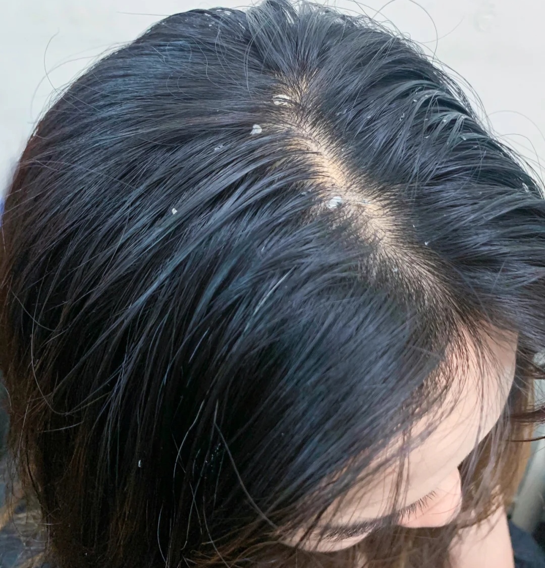 干性头皮屑去屑洗发水哪种最好,去头屑的洗发水哪一种最好