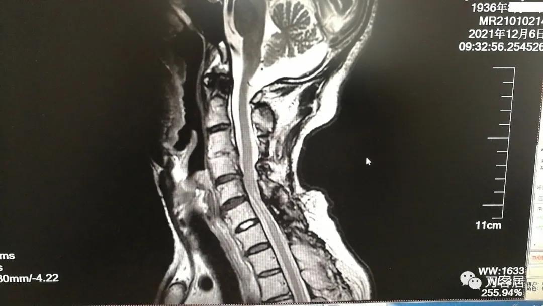 颈椎椎管内肿瘤手术20例麻醉处理,颈椎脊髓内肿瘤手术成功案例