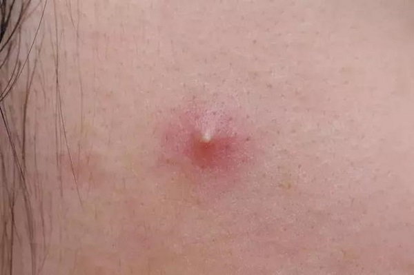 如何正确选择适合自己的皮肤类型,五种肤质的肤质特点和护理方法