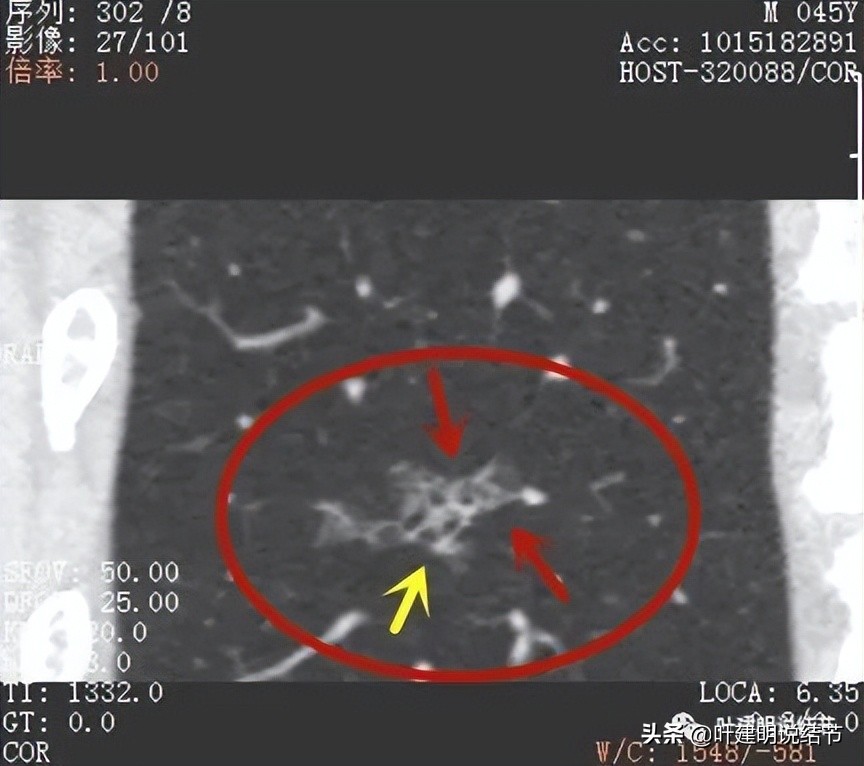 误诊肺纤维化,肺蜂窝状是癌吗