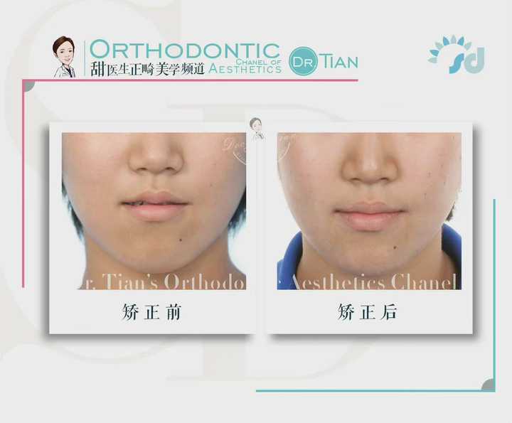 偏侧咀嚼脸型不对称的补救方法,大小脸不对称矫正