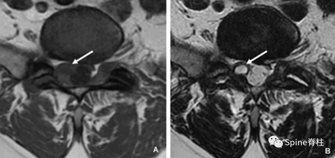 腰椎椎管有囊性结构,水平椎管内囊性占位