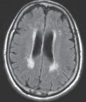 脑水肿的影像,脑水肿形成机制生理学