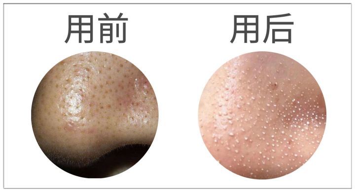 20年的黑头有多大,世界上最长的黑头到底有多长