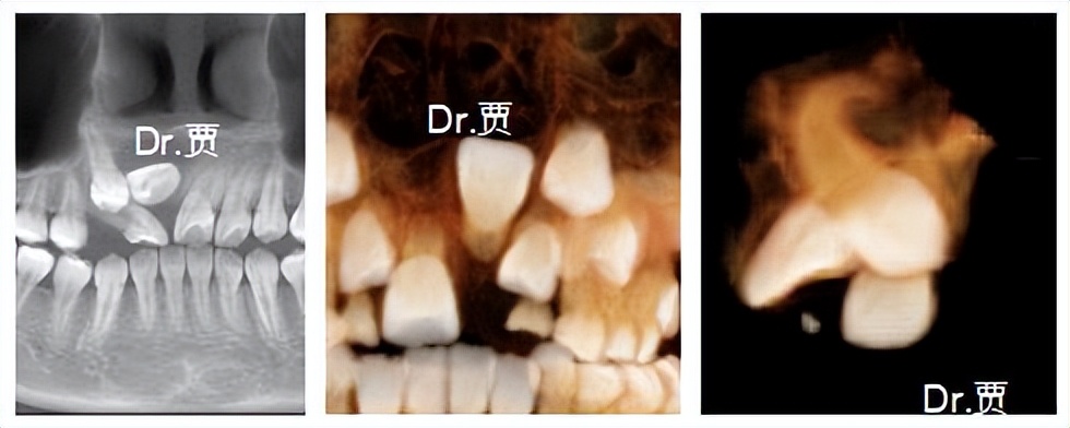 孩子门牙一直长不出来拍片子,儿童门牙一个不长需要看医生吗