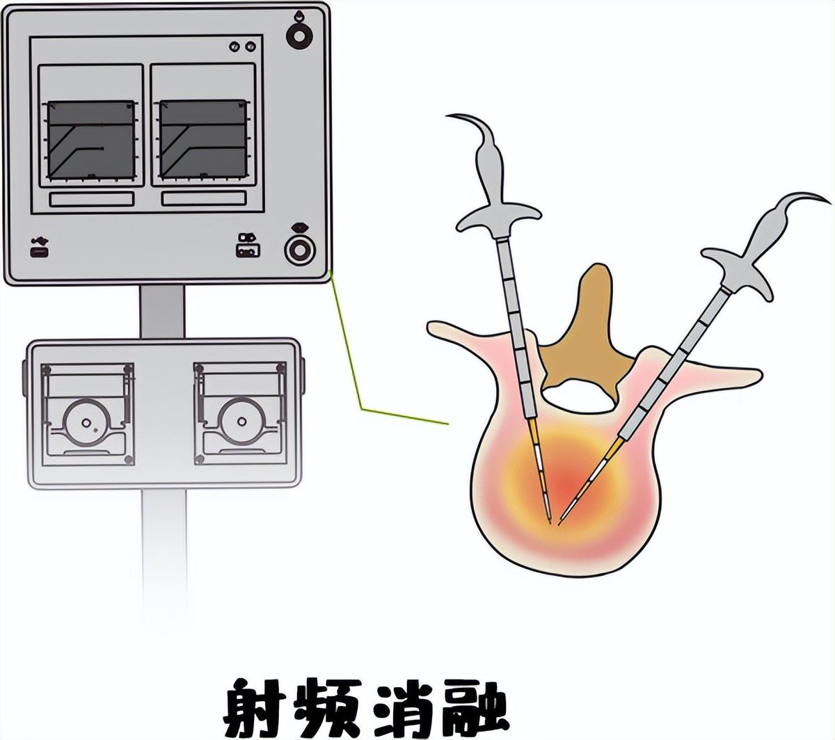 低温等离子射频消融技术应用,抗癌疗法有新突破吗