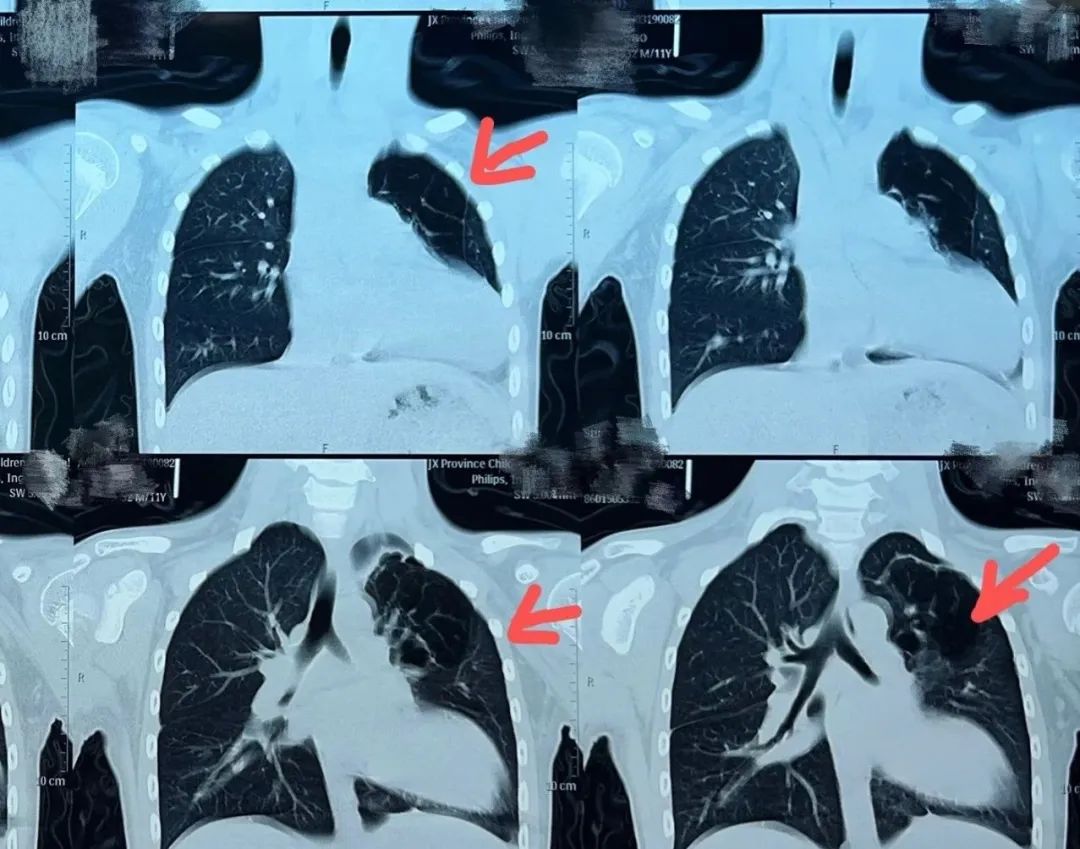 10岁男童新冠肺炎并发呼吸衰竭,11岁男孩确诊肺炎