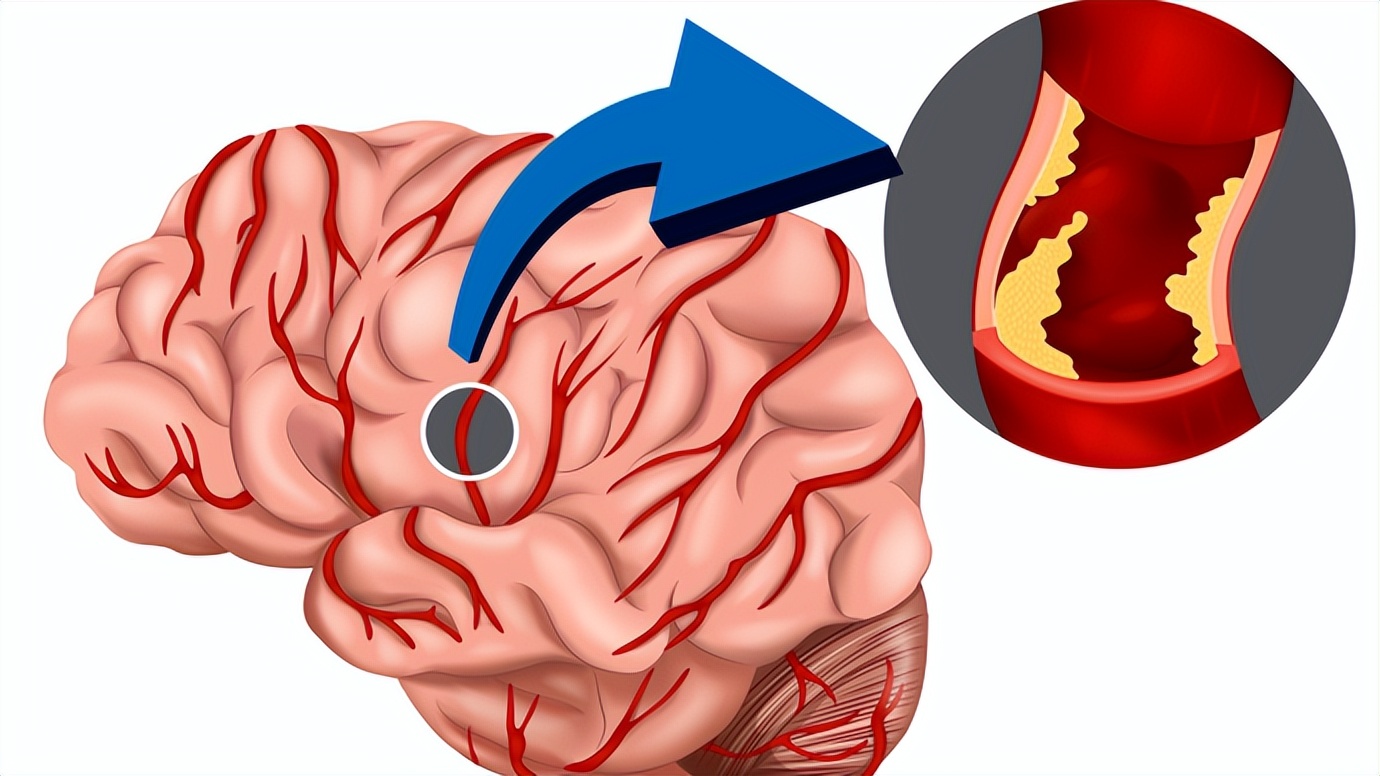 脑血栓患者如何饮食？牢记这五点，对你有帮助