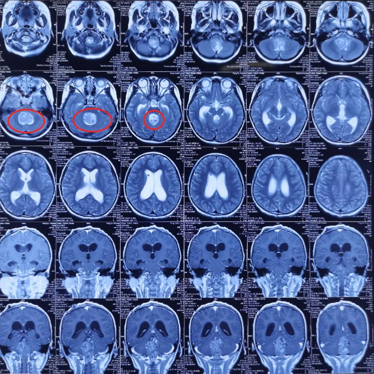 第四脑室室管膜瘤手术怎么做,第三脑室管膜瘤治疗方法