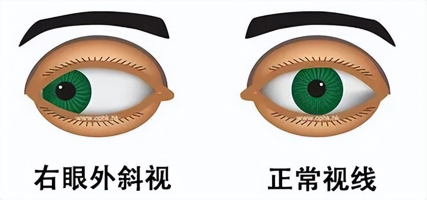 斜视小朋友怎么防控近视,孩子近视外斜视怎么办