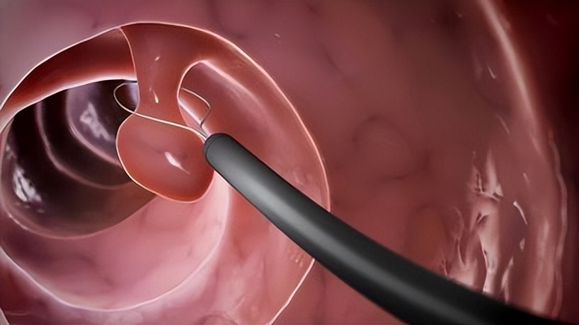 怎么预防肠息肉不再复发,怎样预防肠息肉术后复发