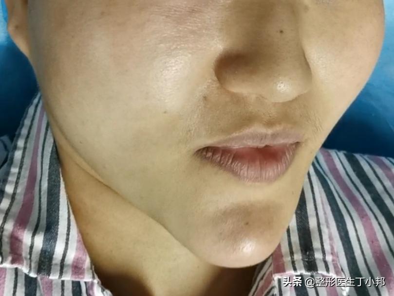 注射生长因子丰下巴导致下巴变形，怎么办？