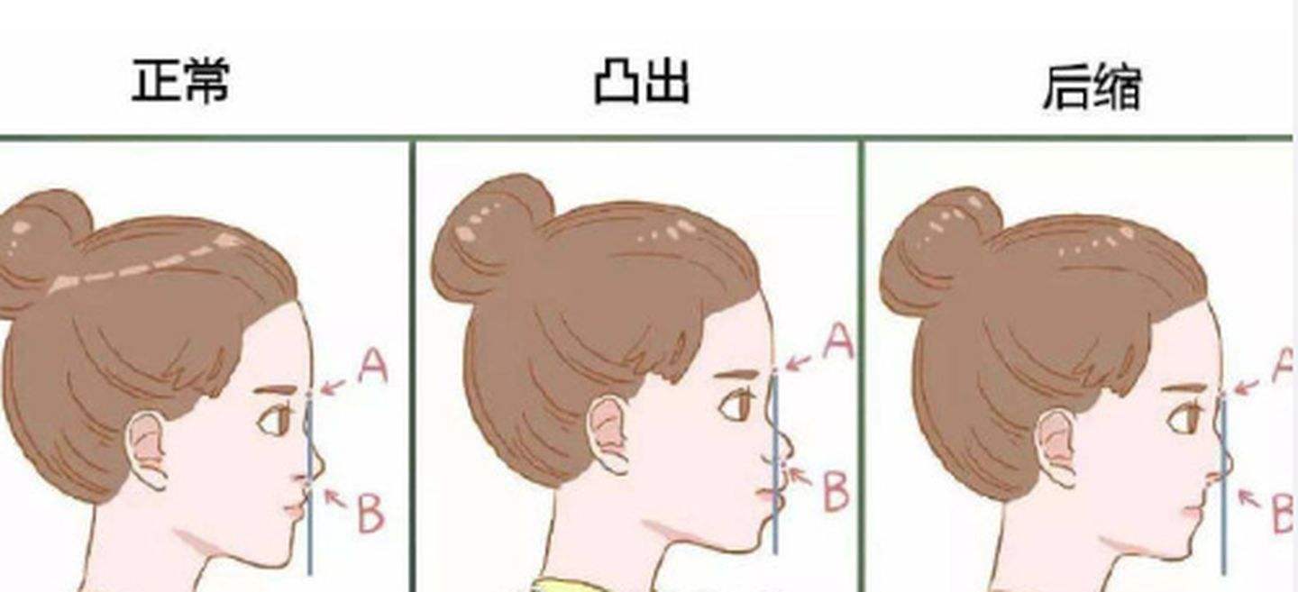 怎样判断凸嘴还是下巴后缩,怎样判断是不是骨性凸嘴