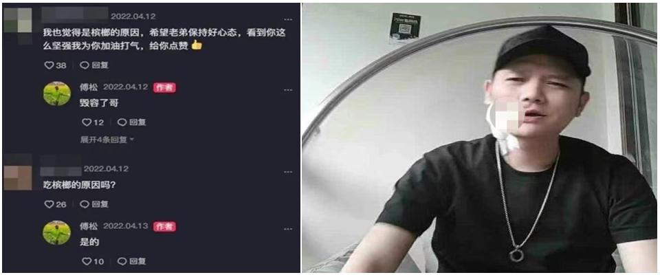 口腔癌离世明星,知名歌手因口腔癌离世